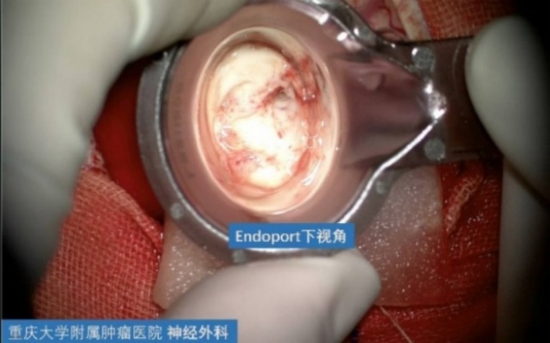 重庆大学附属肿瘤医院神经外科手术集锦：Endoport下脑室巨大占位性病变切除术